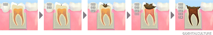 むし歯の進行