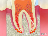外科的歯内療法