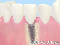 インプラント